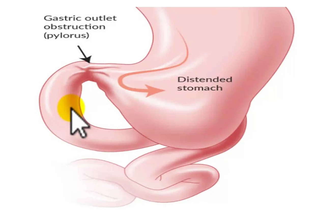 Gastric Disorders